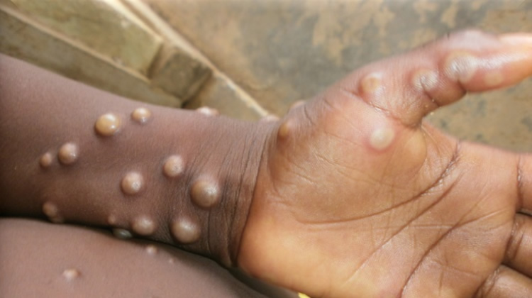 Mpox: Nigeria records 789 cases, eight deaths